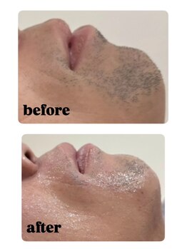 ナルフロウ(nalufurou)/ヒゲ脱毛