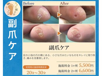 巻き爪補正店 枚方店/副爪ケア