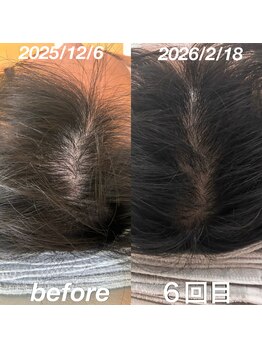 経堂鍼灸整体院/育毛促進鍼+ヒト幹細胞培養液