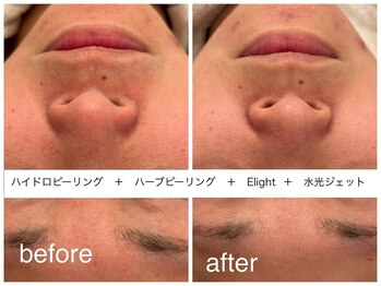 【10年先も続く美しさへ】Maison Ruban 天王寺店|ニキビ・毛穴・小顔・たるみ/毛穴洗浄・ハーブピーリング