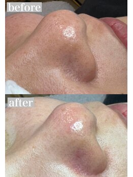 ライカブルー(RaicA BluE)/施術写真　before-after