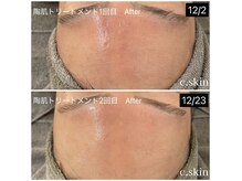 シースキン 盛岡駅前店(c.skin)の雰囲気（REVIホームケアを併用する事でより早いスピードで美肌へ！）