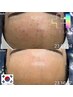《プラズマ》韓国Dr.開発最新技術！CURAIM問題性肌ケア　¥18,000→