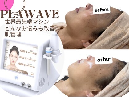 エピリア(Epilear)の写真
