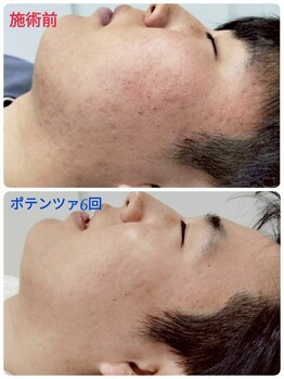 縁(en)/メンズ　ポテンツァ