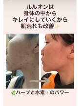 ヨサパーク ラブリエ 吉祥寺店(YOSA PARK La Briller)/肌荒れ改善