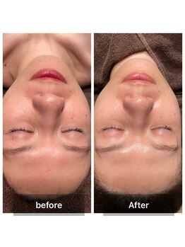 サンタ(SANTA.)/ララピール《ビフォーアフター》