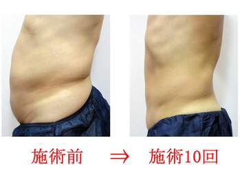 東京美容整体の写真/品川駅徒歩3分★春夏に気になるぽっこりお腹に！皮下脂肪分解×代謝アップで引き締まった体へ
