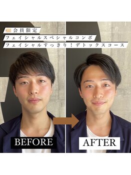 東京デトックス/インディバフェイシャル