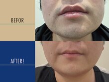 ロペス(Lopez)/【ヒゲ脱毛】10回施術例