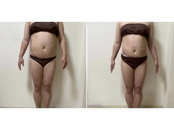 スタートフィットネス プラス エステ/ビフォーアフター