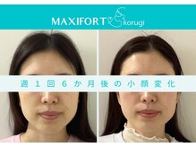 マキシフォート 名駅店(Maxifort)/週1回6ヶ月後の小顔変化