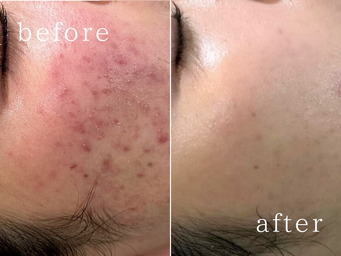 ハーブピーリング&フェイシャルサロン シーベル 福岡天神