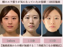 フラン(franc)/エラ張りスッキリ