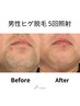 抜け感実感！ヒゲ脱毛　¥15,000  →  ¥5,000
