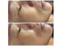 トレア(TREA)の雰囲気(SNSで話題のラミネーションピール!1度でシワ撲滅×艶肌実感☆)