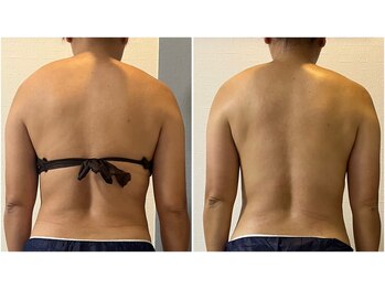 モア(moa)/痩身2回目