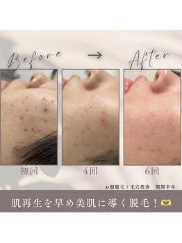 モアトゥインクル 山口店(MORE twinkle)/★症例写真★【20代】