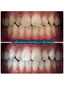 ホワイトニングショップ 刈谷店/Before&After美白ホワイトニング