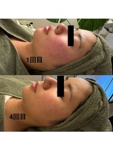 シーアイエステティック 船橋駅前店(c.iエステティック)/お顔のハーブピーリング♪