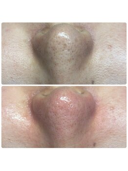 ユニ(uni.)/毛穴エクストラクション