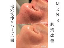 ビジュープラス 水戸店(Bijou+)/鼻の黒ずみ改善