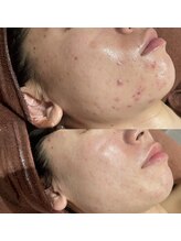 ミャオ(Meow!)/REVIハーブピーリング