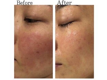 ハイケア グラン ギンザ(HYCARE GRAND GINZA)/日本ーの肌改善サロン実力/銀座