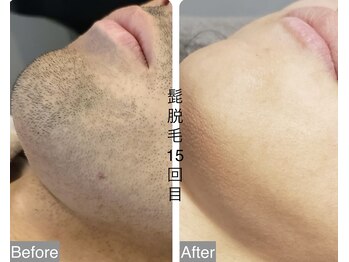 CDF 赤坂/メンズヒゲ脱毛15回目初回￥1000