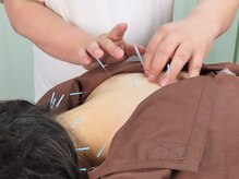 梅沢鍼灸院/首肩こりへ鍼を