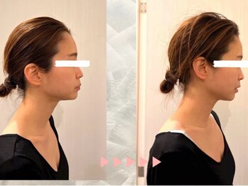 サリー(Sally)/小顔　Bfore After