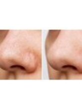 プライベートサロン 美月/いちご鼻　毛穴徹底洗浄