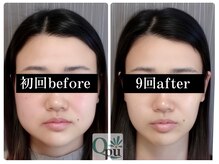 キュープ 福岡天神店(Qpu)/美顔器コース９回での変化