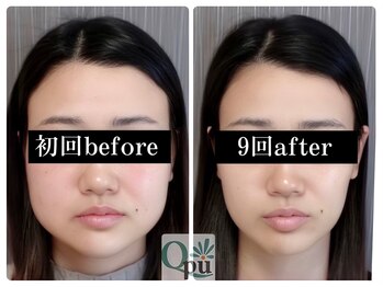 キュープ 福岡天神店(Qpu)/美顔器コース9回での変化