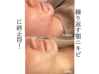 ビジュープラス 水戸店(Bijou+)/顎ニキビケア