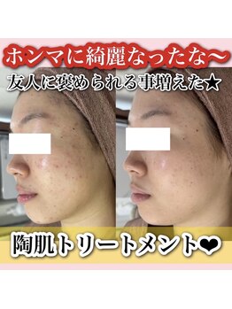 アルムダアクア 天王寺店(Aleumda AQUA)/ハーブピーリング/大阪/天王寺