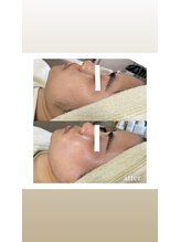 ミーミドットアイ(Mi-mi.i)/艶肌フェイシャルワックス脱毛