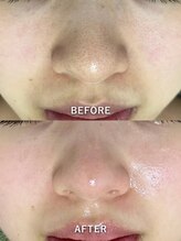サロンドジェシカ(salon de Jessica)/カーボキシー＋毛穴洗浄