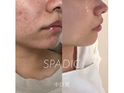 スペイディック(SPADIC)の写真
