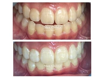 モンシェリ 広島店(Mon Cheri)/ホワイトニングBefore→After