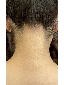 リバース(Rebirth)/うなじシェービング・ビフォー