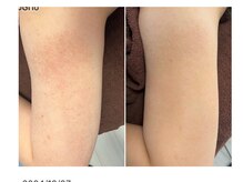 エミルカ 神戸三宮(EMILUCA)/毛孔性苔癬