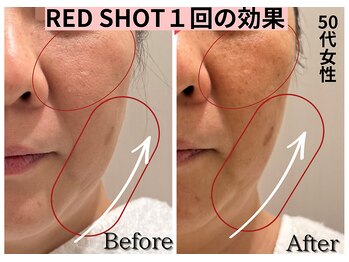 エトワール(etoile)/初めてのレッドショット☆