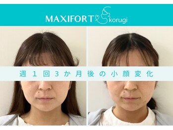 マキシフォート 名駅店(Maxifort)/週1回3ヶ月後の小顔変化