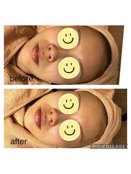 フェリース鍼灸院/ララピール 1回