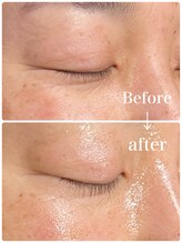 モデラート(moderate)/目元小じわ