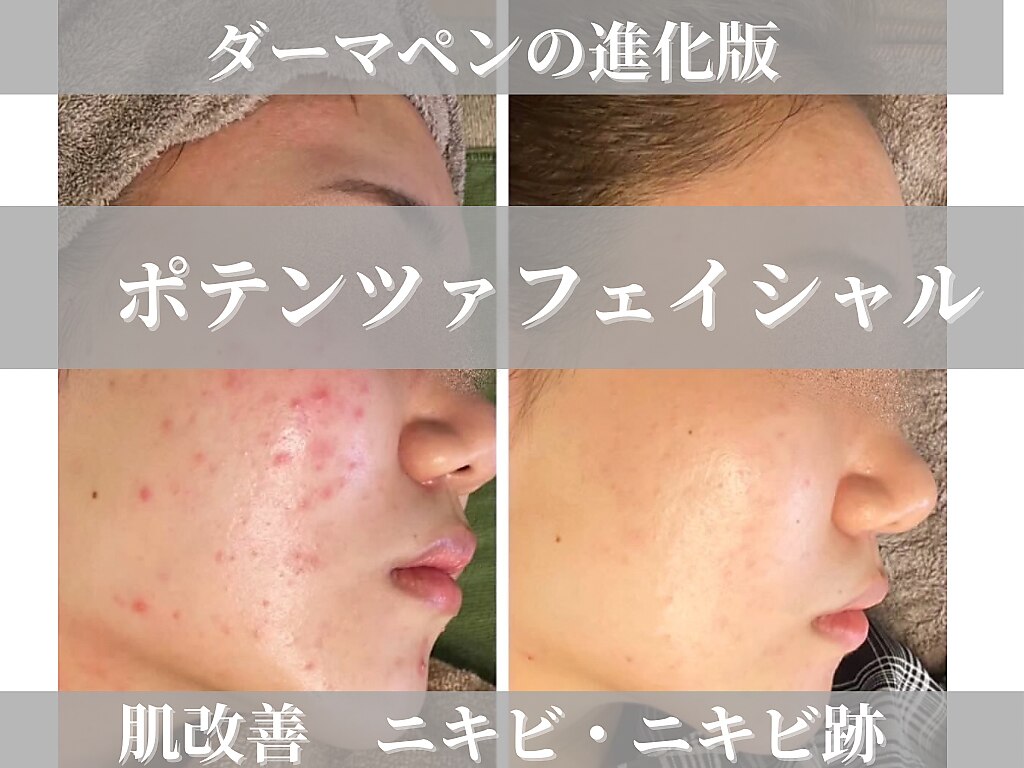 福島県で毛穴黒ずみが人気のエステサロン｜ホットペッパービューティー