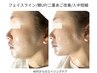 人気No.1【たるみ・毛穴改善★】プラズマサーマルフェイシャル♪