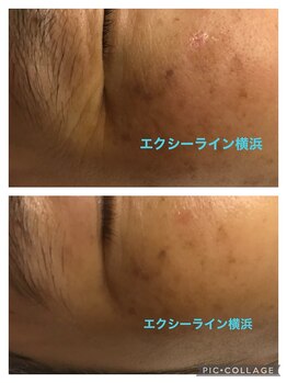 エヴァーグレース 横浜店/目元のしわケアにも♪