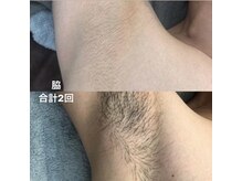 ディライト 名古屋駅店(Delight)/ワキ脱毛